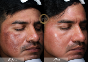 Dr. Qazi treats melasmas and dark spots with lasers and a proprietary method preparing the skin to heal